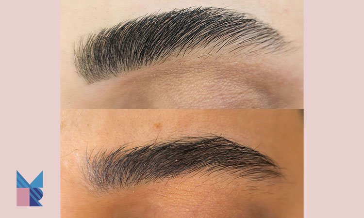 اصلاح و قرینه سازی و هایپر لیفت ابرو