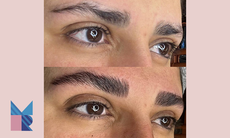 مدت زمان رشد نهایی ابرو بعد از کاشت FUT