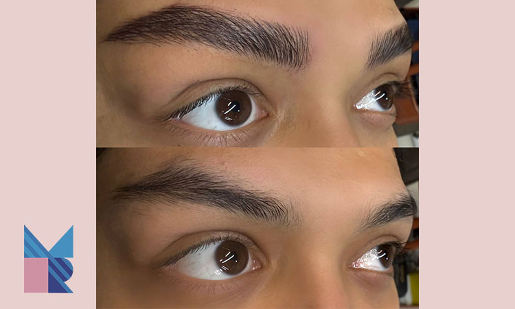 مزاحل اجرا کاشت به روش fut