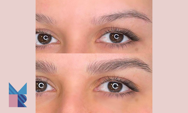 مزایا کاشت ابرو به روش fut